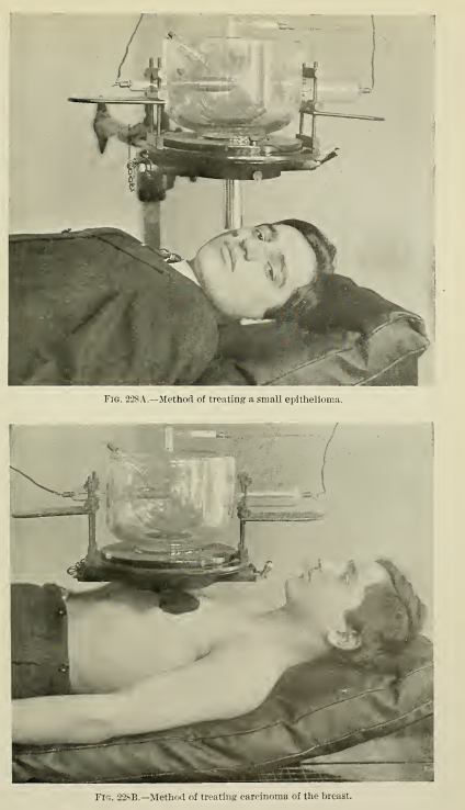 Fuente: Röntgen Rays and Electro-therapeutics - Mihran Krikor Kassabian 1907